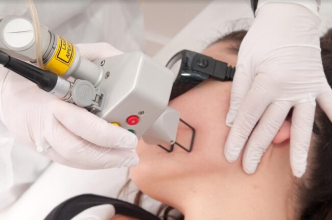 Fractional Laser CO2 Fractional Laser CO2