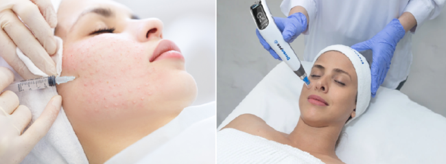 μεσοθεραπεία vs microneedling (1)