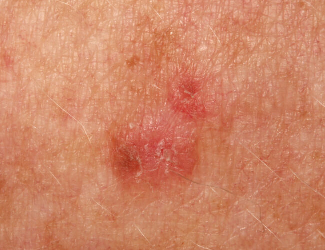 actinic keratosis 1
